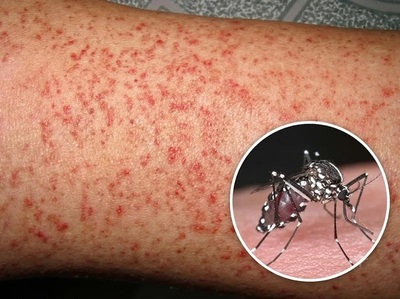 Muỗi Aedes truyền virus Dengue gây bệnh sốt xuất huyết ở người.